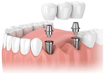 Illustrative image for 3 unit bridge procedure