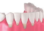 Teeth with gum disease
