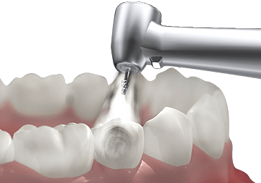 Illustrative image of endodontics procedure