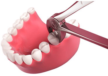 Illustrative image of forceps extracting a tooth