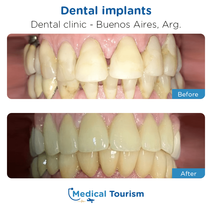 dental clinic before and after of patients in Buenos Aires