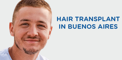 Hair transplant in Buenos Aires