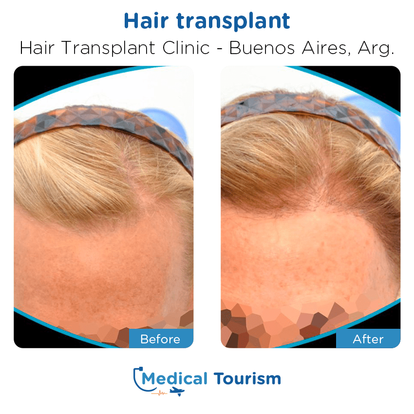 hair transplant clinic  before and after of patients in Buenos Aires