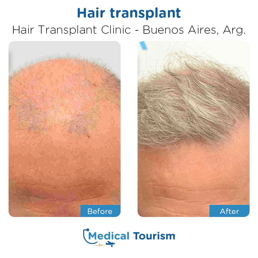 hair transplant clinic  before and after of patients in Buenos Aires