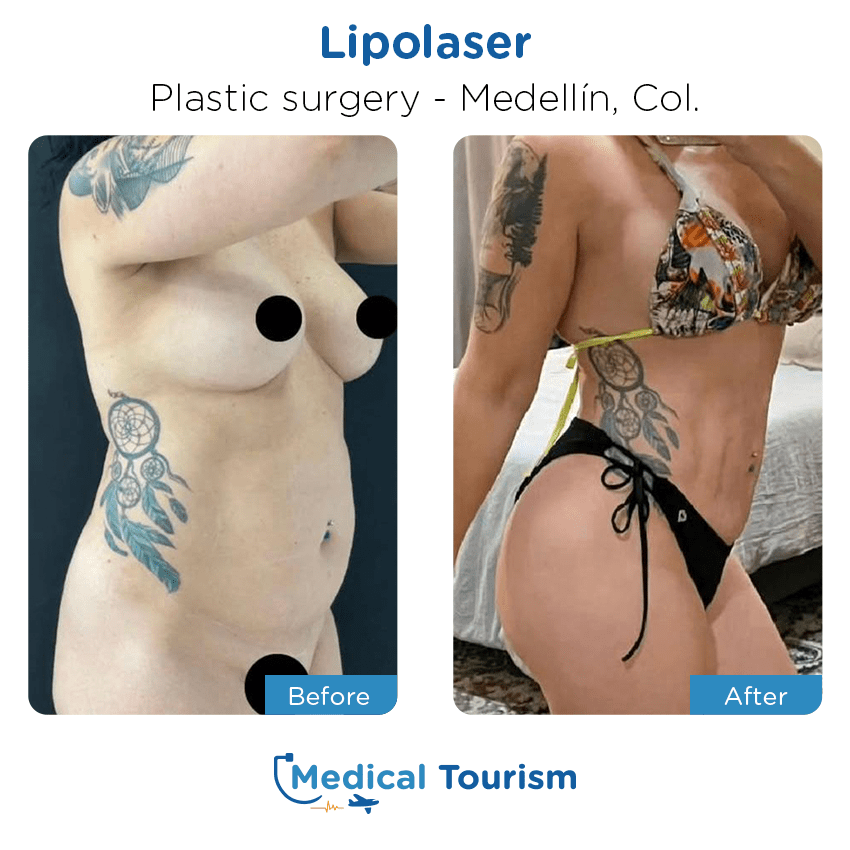 plastic surgery before and after of patients in Medellín