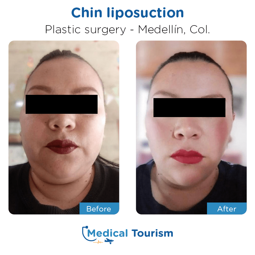 plastic surgery before and after of patients in Medellín
