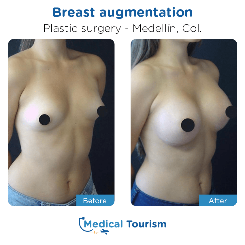 plastic surgery before and after of patients in Medellín