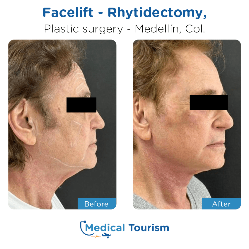 plastic surgery before and after of patients in Medellín