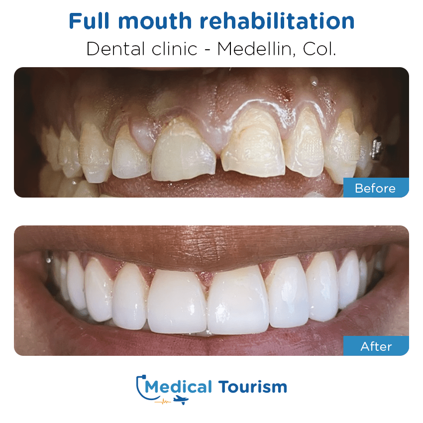 dental clinic before and after of patients in Medellín