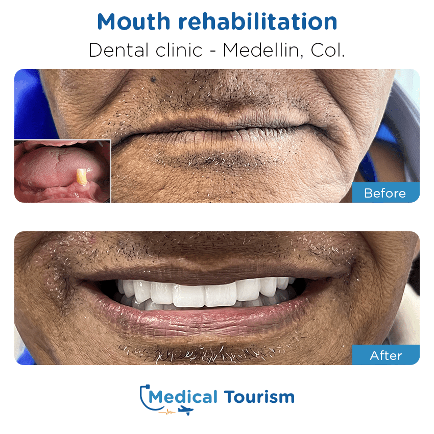 dental clinic before and after of patients in Medellín