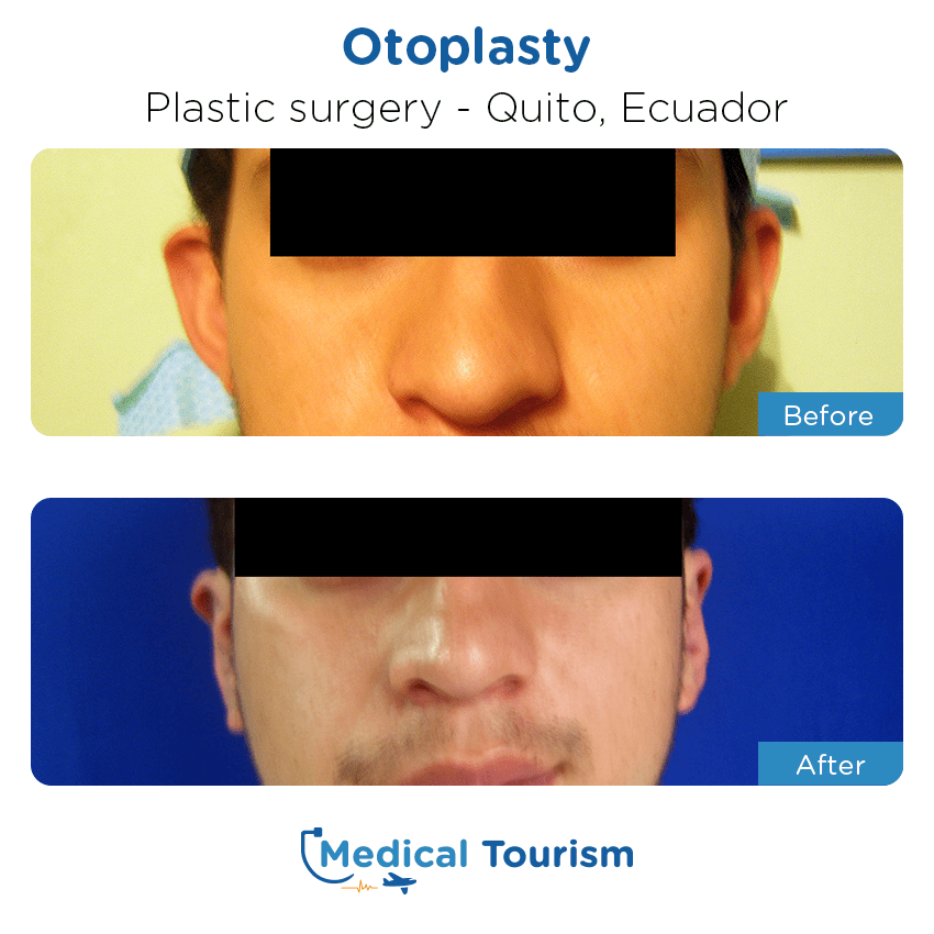 plastic surgery before and after of patients in Quito