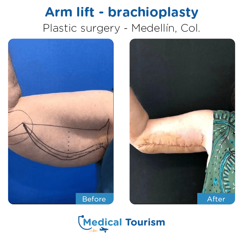 Patient before and after medical tourism