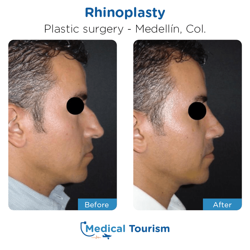 Patient before and after medical tourism