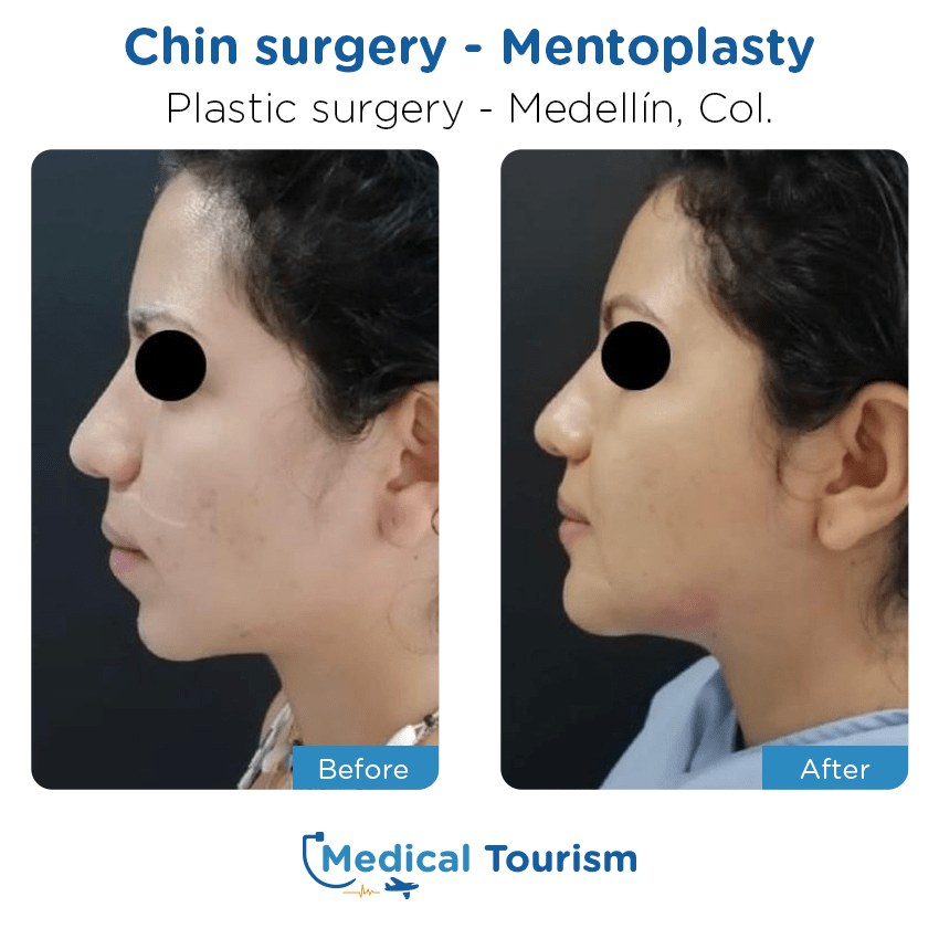 Patient before and after medical tourism
