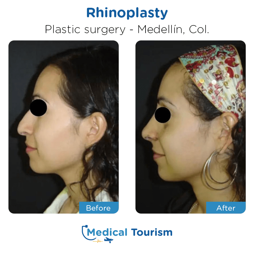 Patient before and after medical tourism