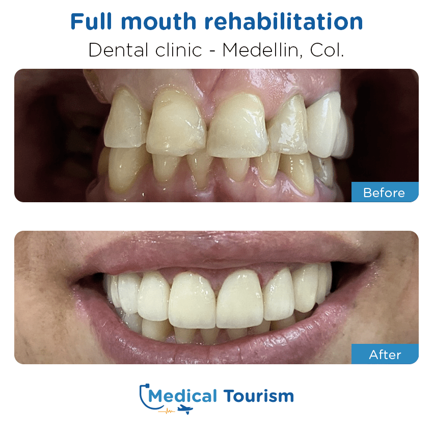 dental clinic before and after of patients in Medellín