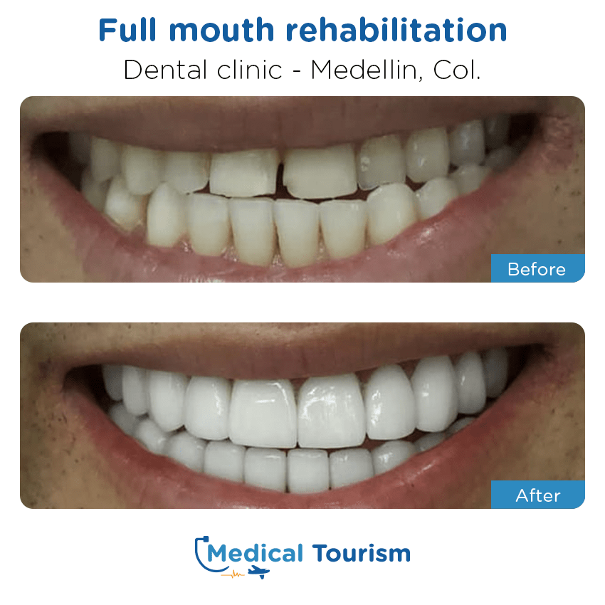 dental clinic before and after of patients in Medellín