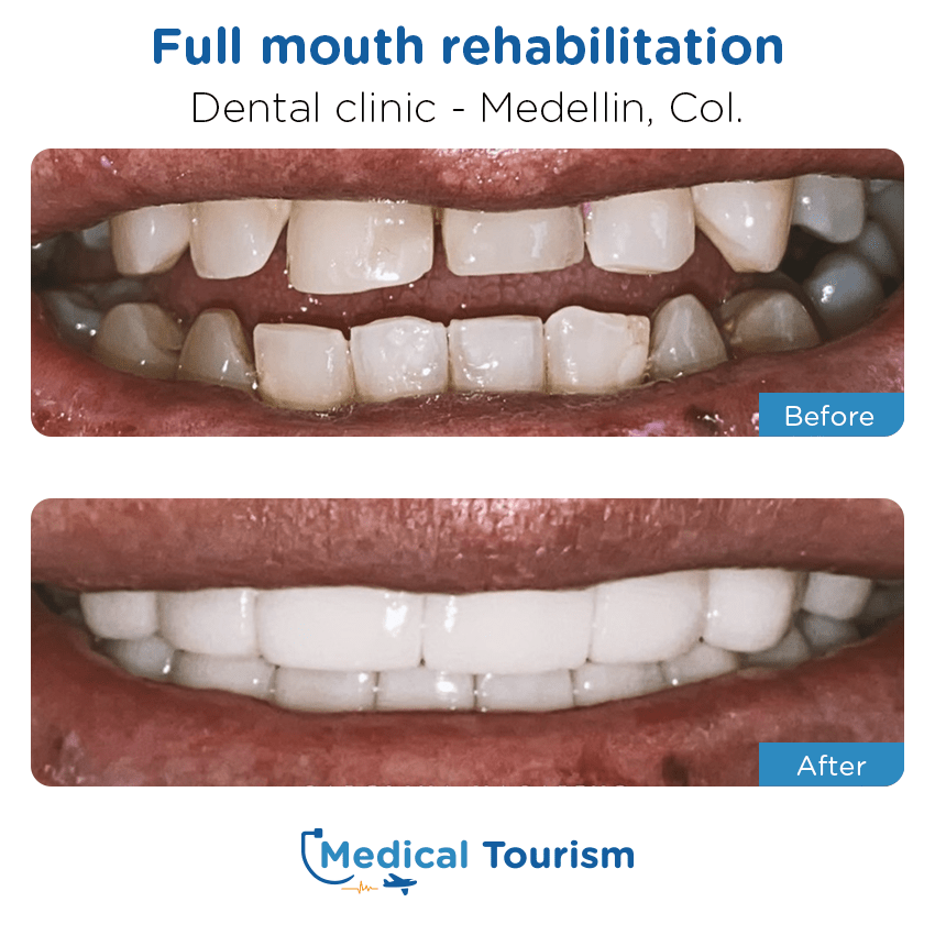 dental clinic before and after of patients in Medellín