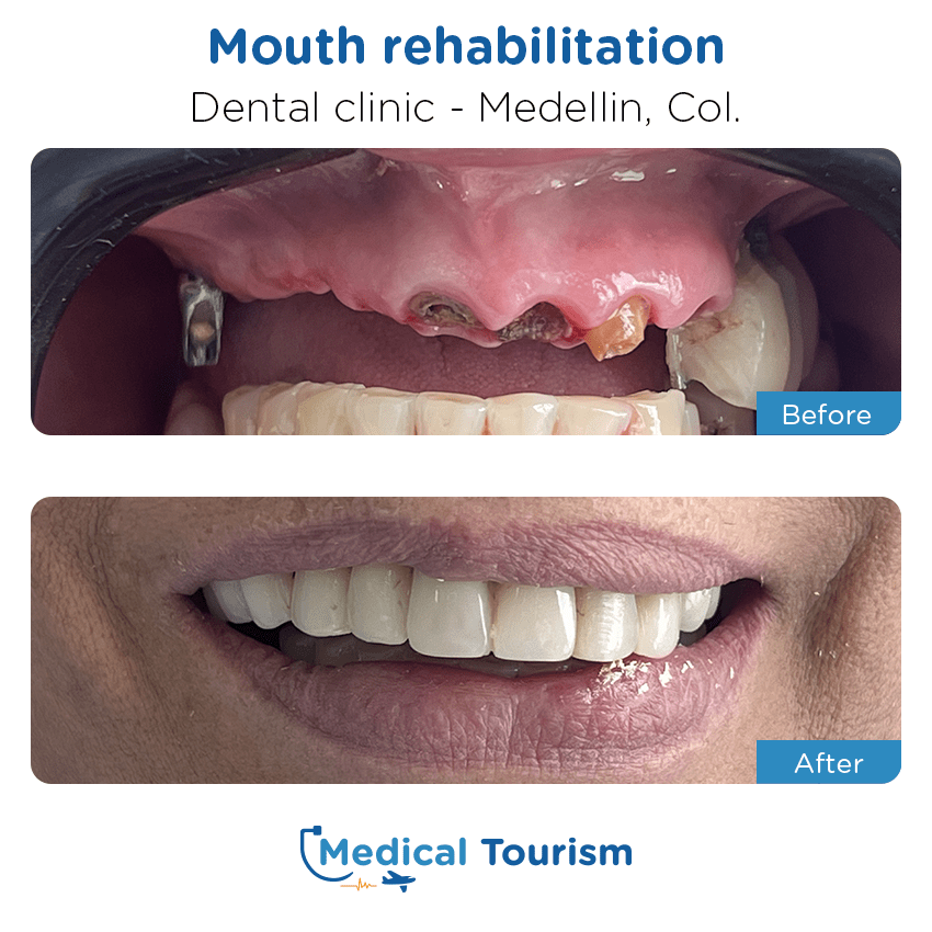 dental clinic before and after of patients in Medellín