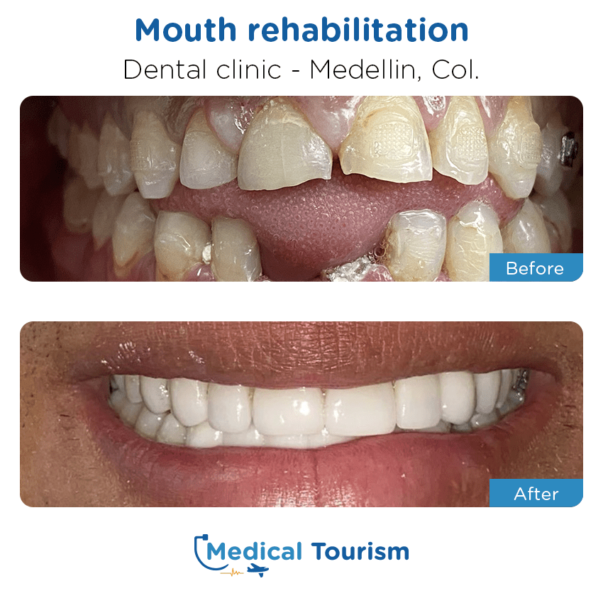 dental clinic before and after of patients in Medellín