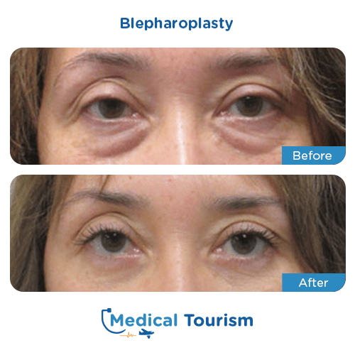 Blepharoplasty before and after medical tourism international