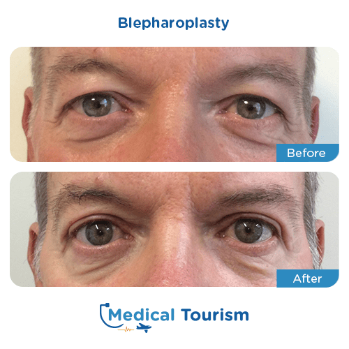 Blepharoplasty before and after medical tourism international