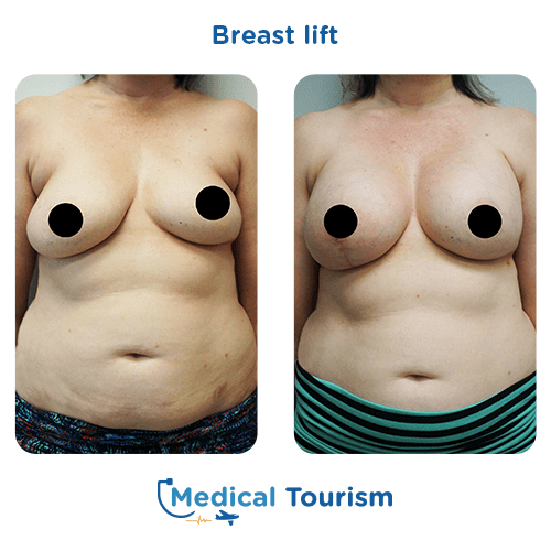 Breast lift before and after medical tourism international