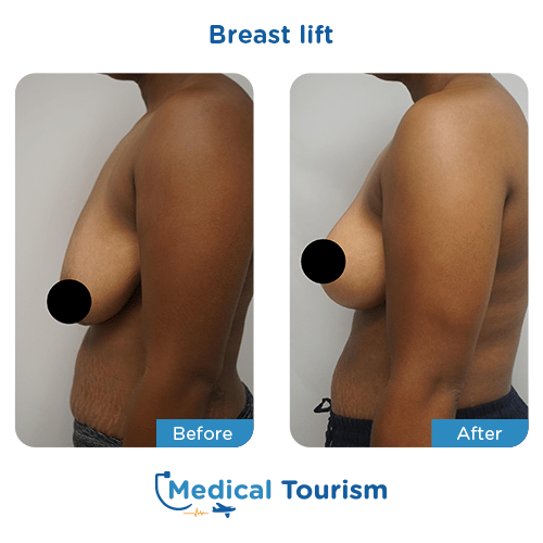 Breast lift before and after medical tourism international