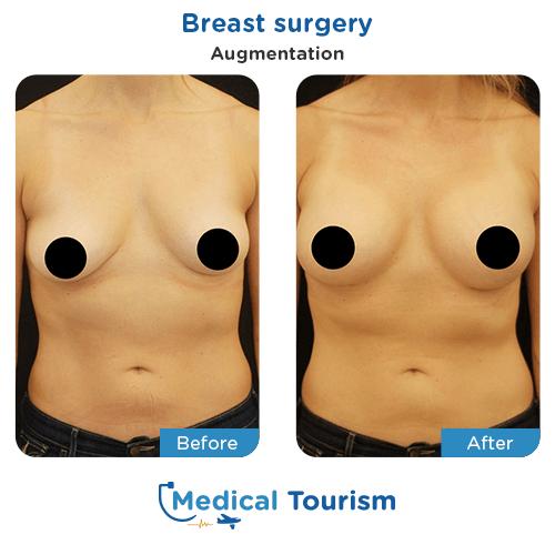 Breast surgery before and after medical tourism international