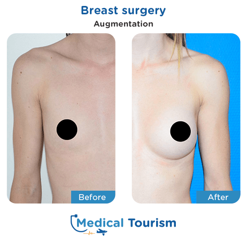 Breast surgery before and after medical tourism international