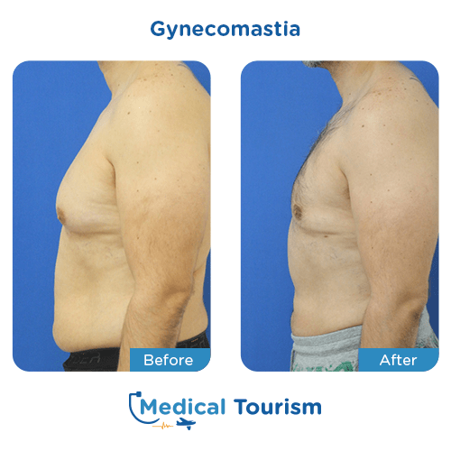 Gynecomastia before and after medical tourism international