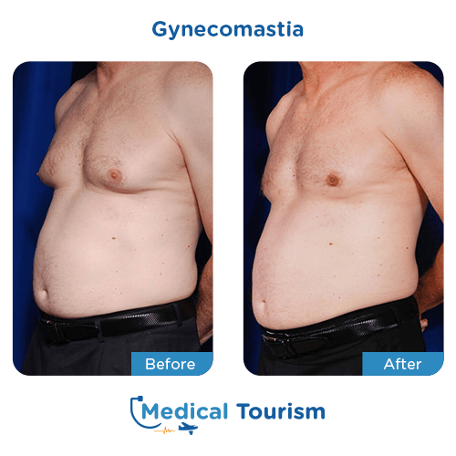 Gynecomastia before and after medical tourism international