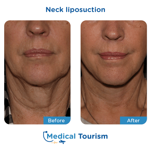 Neck liposuction before and after medical tourism international