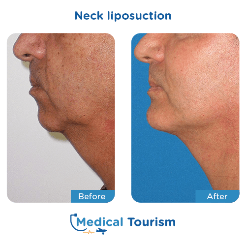 Neck liposuction before and after medical tourism international