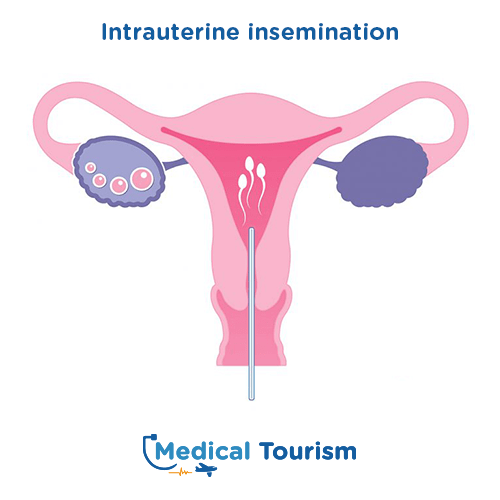 Ad Fertility Clinic Intrauterine Insemination Medical Tourism