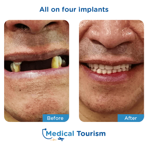 All on 4 before and after medical tourism international