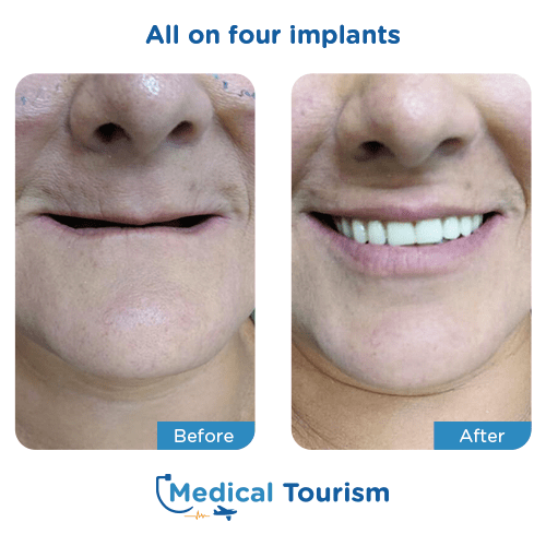 All on 4 before and after medical tourism international