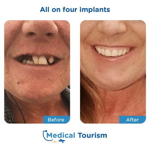 All on 4 before and after medical tourism international