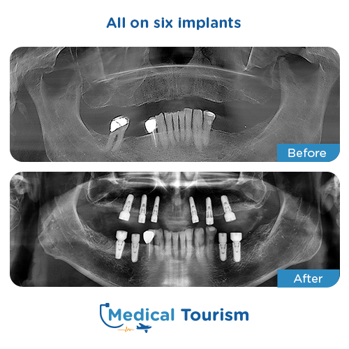All on 6 before and after medical tourism international