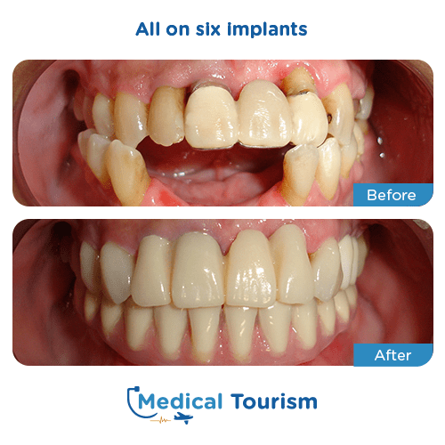 All on 6 before and after medical tourism international
