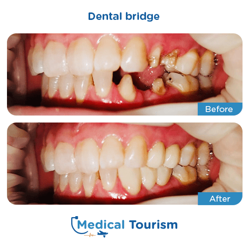 Dental bridge before and after medical tourism international