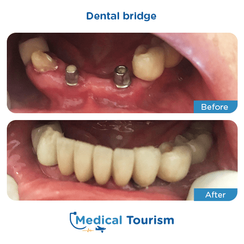 Dental bridge before and after medical tourism international