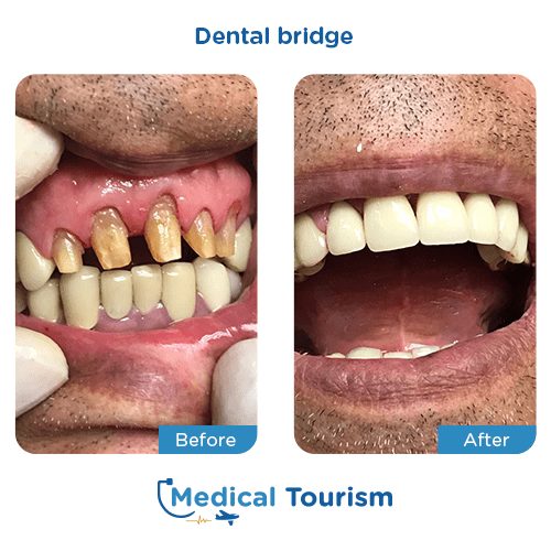 Dental bridge before and after medical tourism international