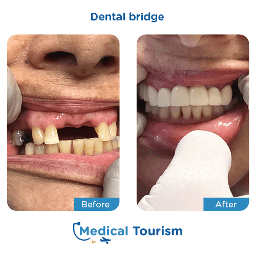 Dental bridge before and after medical tourism international