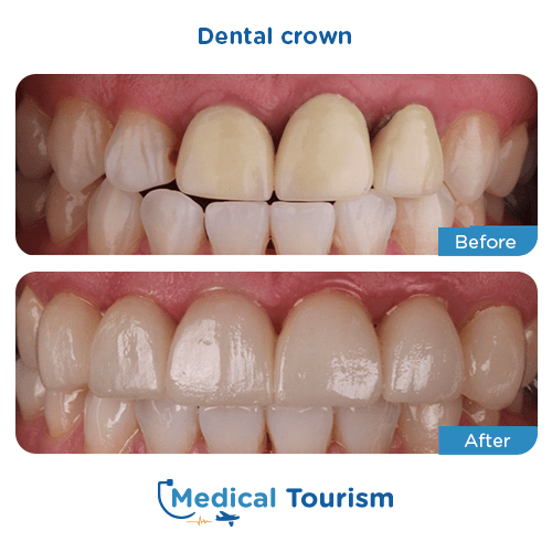 Dental crown before and after medical tourism international