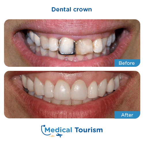 Dental crown before and after medical tourism international