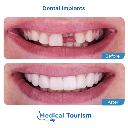 Dental implant before and after medical tourism international