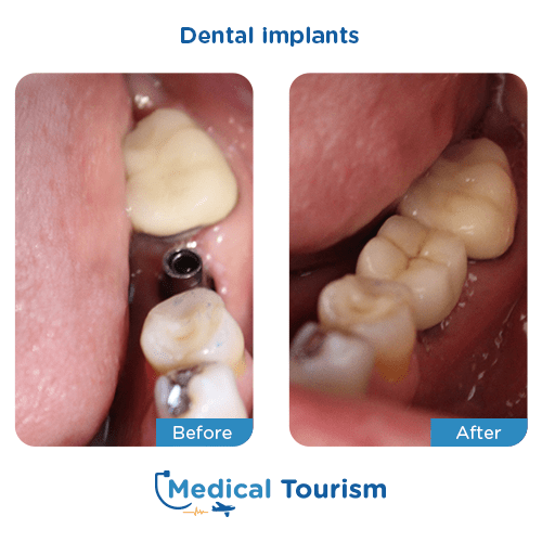 Dental implant before and after medical tourism international