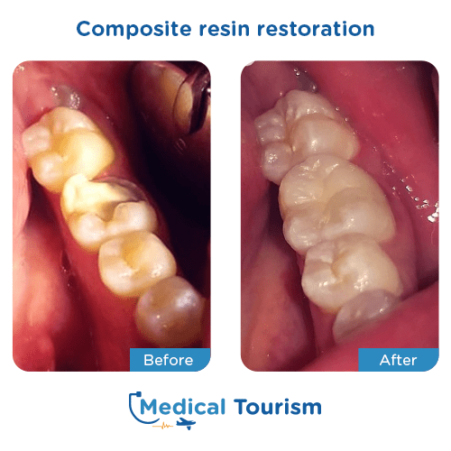 Dental bridge before and after medical tourism international