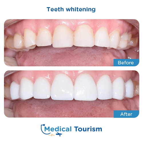 Dental bridge before and after medical tourism international